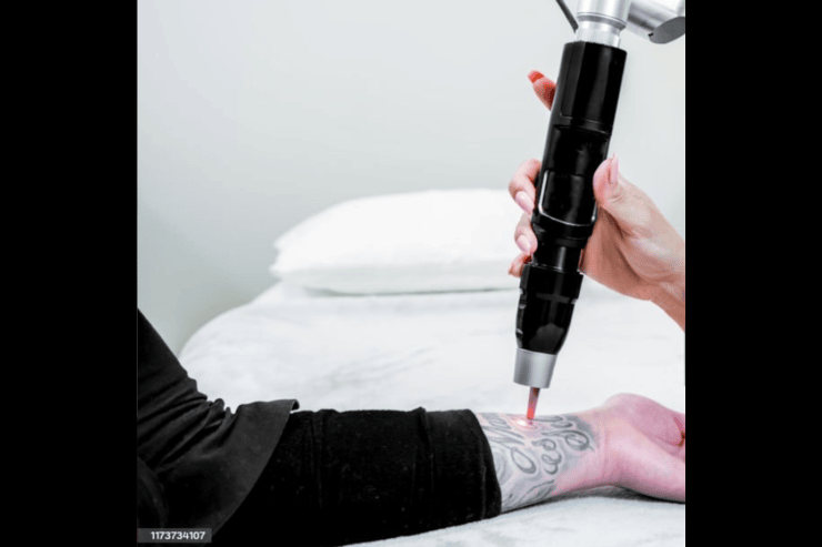 how many sessions do you need for laser tattoo removal?